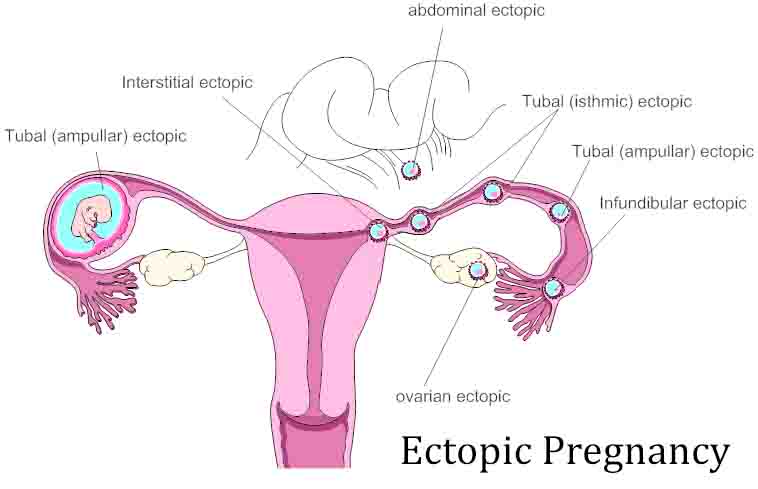 Pregnancy after Ectopic, Test, Ultrasound, Treatment, Surgery 
